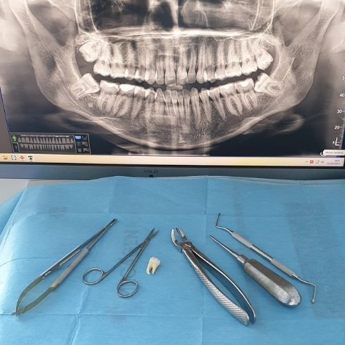 chirurgia orale, strumenti odontoiatrici, radiografia digitale