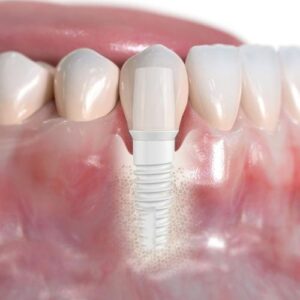 impianto dentale