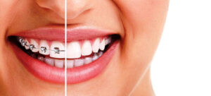 ortodonzia Lecco sorriso metà denti con apparecchio ortodontico