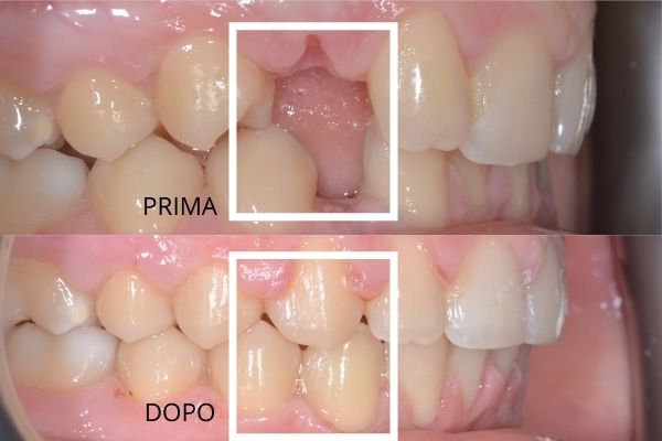 prima e dopo ortodonzia, denti mancanti sopra denti presenti sotto