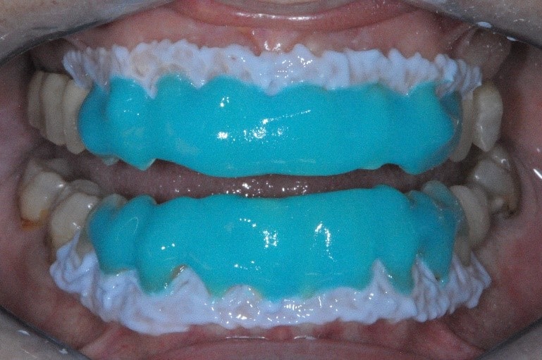 sbiancamento professionale laser: applicazione del gel sbiancante sui denti