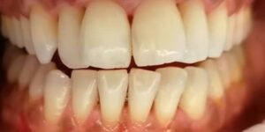 denti dopo lo sbiancamento professionale laser