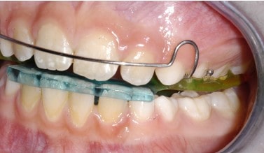 ortodonzia apparecchio funzionale dentista Lecco