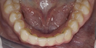 ortodonzia Lecco: contenzione fissa