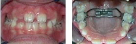 ortodonzia a Lecco: espansore rapido palatale