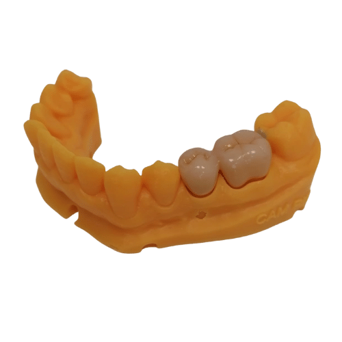 protesi dentaria - due corone in zirconia su modello in resina