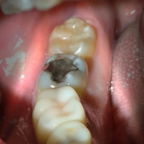 carie dentaria su molare