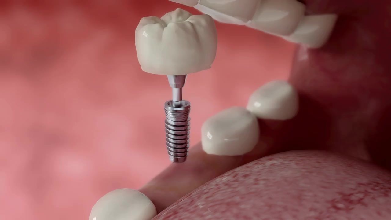 impianto dentale dimostrazione