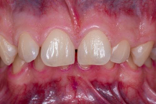 denti senza placca dopo il protocollo GBT