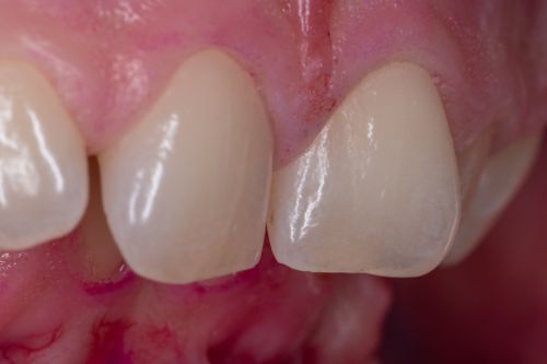 denti puliti dopo gbt