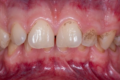denti con placca prima del protocollo GBT