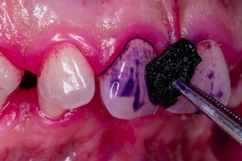rilevatore di placca su denti