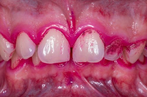 denti con rivelatore di placca